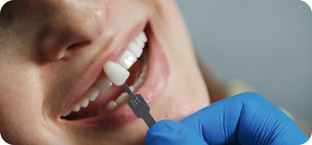 Успей записаться на установку виниров